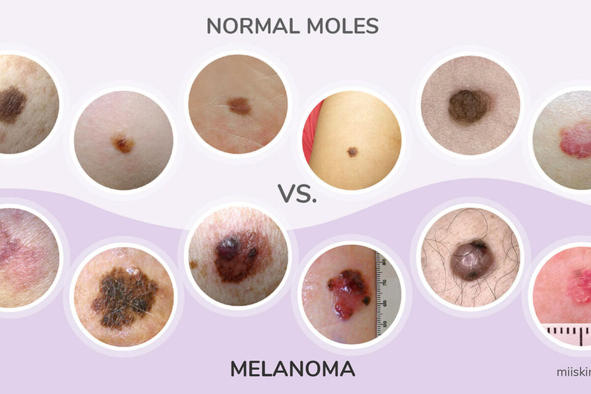 Early Signs of Melanoma Guide – Understanding Symptoms and Visual Changes