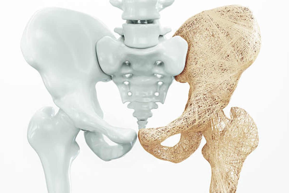 How to prevent osteoporosis? Essential guide for daily life.